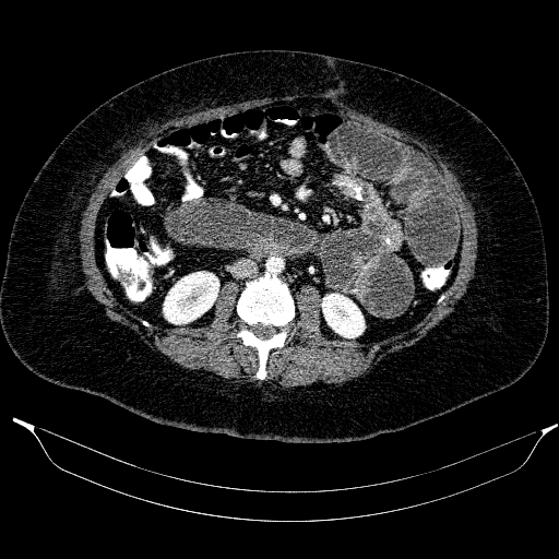Afferent loop syndrome - secondary to incarcerated trocar site hernia (Radiopaedia 82959-97305 Axial C+ portal venous phase 117).jpg
