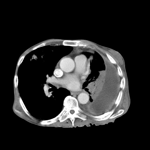 Aggressive lung cancer with cardiac metastases, pulmonary artery tumor thrombus, and Budd-Chiari (Radiopaedia 60320-67981 A 31).jpg