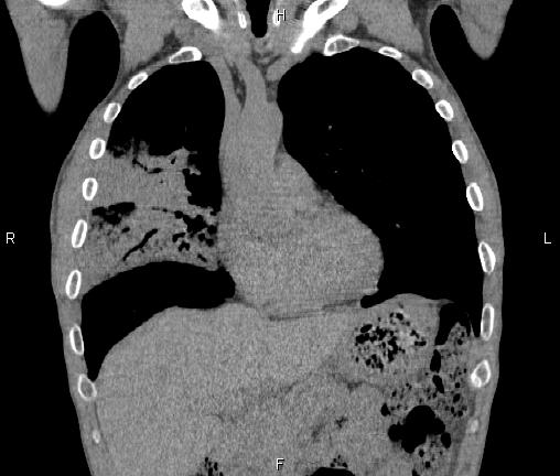 Air bronchogram in pneumonia (Radiopaedia 85719-101512 Coronal non-contrast 20).jpg