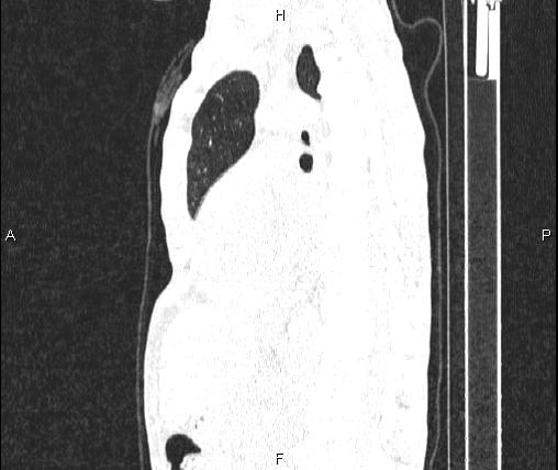 Air bronchogram in pneumonia (Radiopaedia 85719-101512 Sagittal lung window 54).jpg