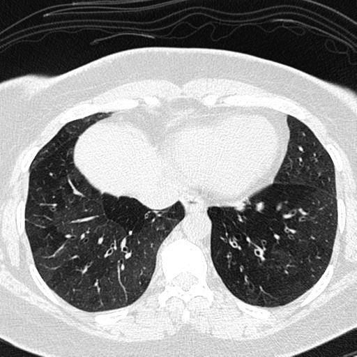 Air trapping in small airway disease (Radiopaedia 61685-69694 Axial lung window 136).jpg
