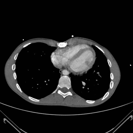 File:Alagille syndrome with pulmonary hypertension (Radiopaedia 49384-54980 A 11).jpg