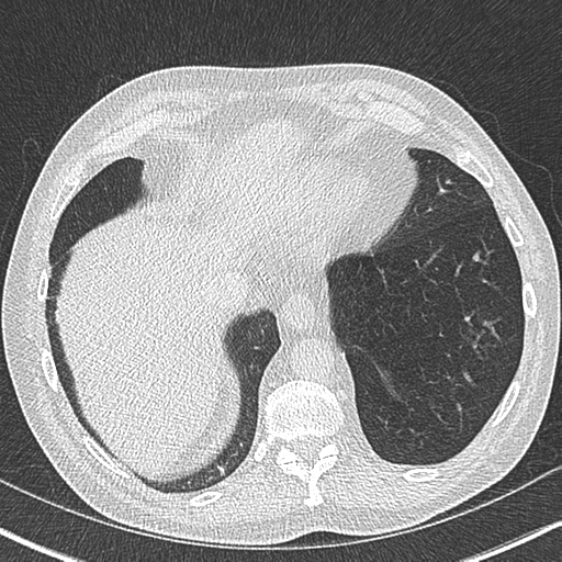 File:Allergic bronchopulmonary aspergillosis (Radiopaedia 44760-48571 Axial lung window 52).png