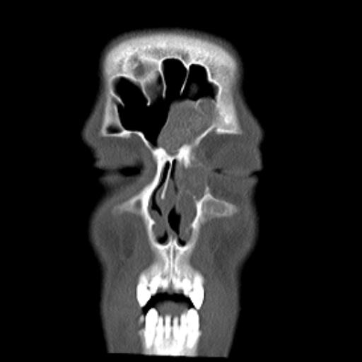 File:Allergic fungal sinusitis (Radiopaedia 29086-29455 Coronal bone window 18).jpg