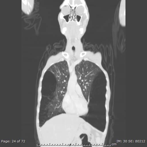 Alpha-1-antitrypsin deficiency (Radiopaedia 50561-55987 Coronal lung window 22).jpg
