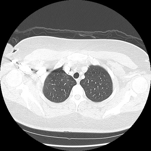 Alveolar soft part sarcoma - right leg (Radiopaedia 59432-67091 Axial lung window 21).jpg