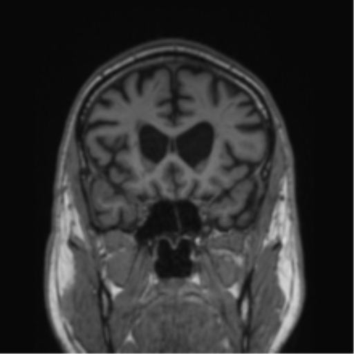 Alzheimer's disease- with Gerstmann syndrome and dressing apraxia (Radiopaedia 54882-61150 Coronal T1 63).png