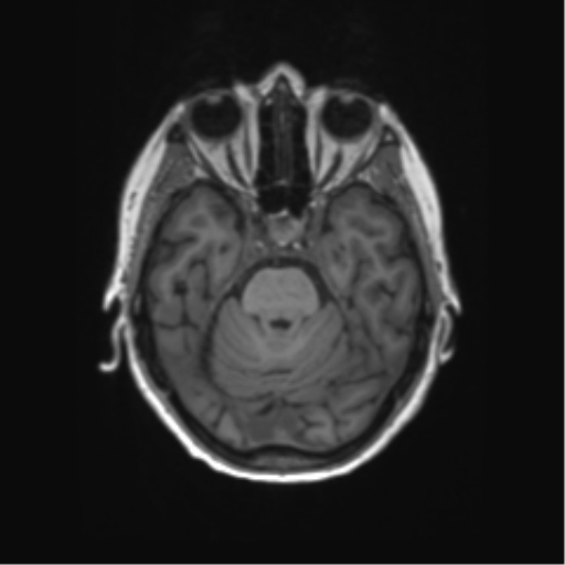 File:Alzheimer's disease (Radiopaedia 42658-45802 Axial T1 106).png