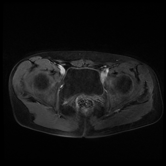 Ambiguous genitalia (Radiopaedia 69686-79643 Axial T1 C+ fat sat 32).jpg