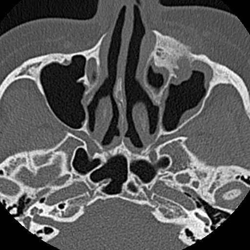File:Ameloblastic fibro-odontoma (Radiopaedia 18843-18780 C 13).jpg