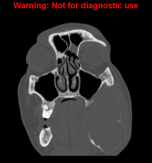 File:Ameloblastoma (Radiopaedia 13276-13280 Coronal non-contrast 7).jpg