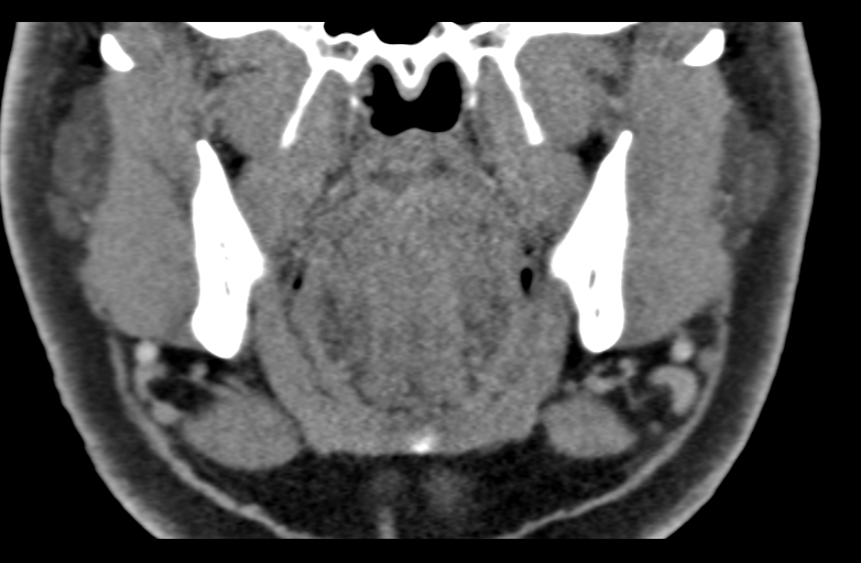 Ameloblastoma (Radiopaedia 33677-34806 Coronal non-contrast 32).png