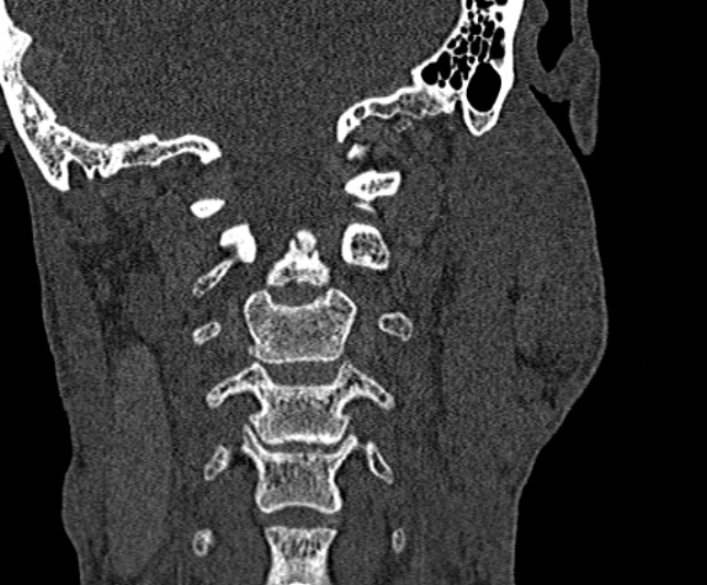 Ameloblastoma (Radiopaedia 51921-57766 Coronal bone window 245).jpg