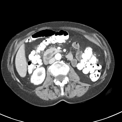 Ampullary adenocarcinoma (Radiopaedia 34013-35237 C 22).png