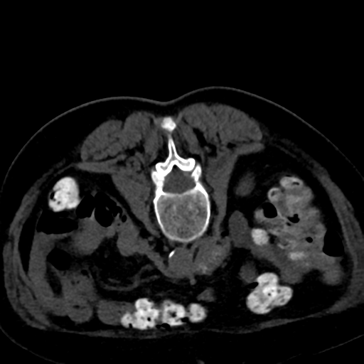 Ampullary adenocarcinoma (Radiopaedia 34013-35241 C 59).png