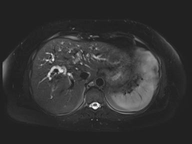 Ampullary adenocarcinoma (Radiopaedia 54765-61014 Axial T2 space-FS 17).jpg