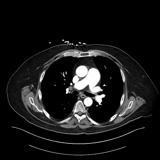 Ampullary adenocarcinoma (Radiopaedia 59373-66734 A 3).jpg