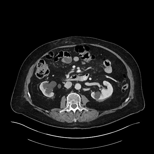 Ampullary adenocarcinoma (Radiopaedia 59373-66734 C 73).jpg
