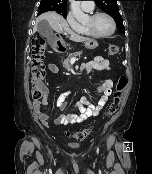 Ampullary adenocarcinoma (Radiopaedia 59373-66734 D 33).jpg