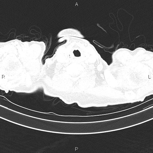 Ampullary adenocarcinoma (Radiopaedia 86093-102033 Axial lung window 6).jpg
