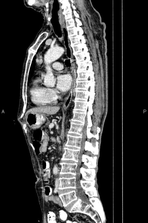 Ampullary adenocarcinoma (Radiopaedia 86093-102033 E 48).jpg