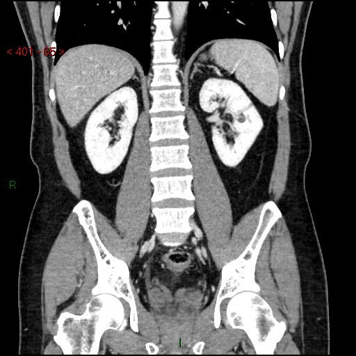Ampullary carcinoma (Radiopaedia 56396-63056 E 64).jpg