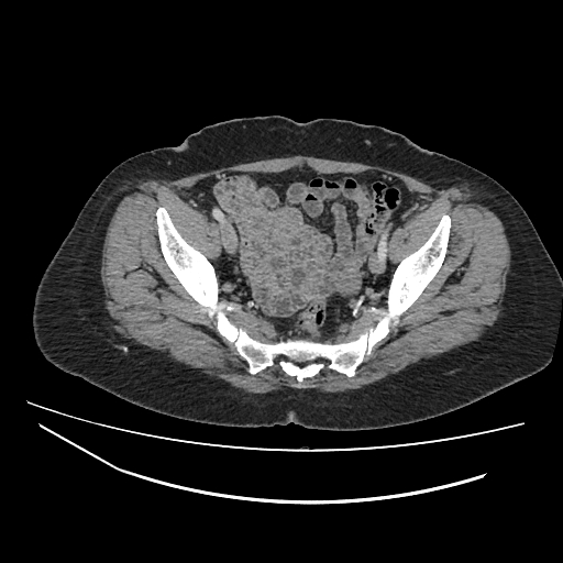 File:Ampullary tumor (Radiopaedia 60333-67998 A 76).jpg