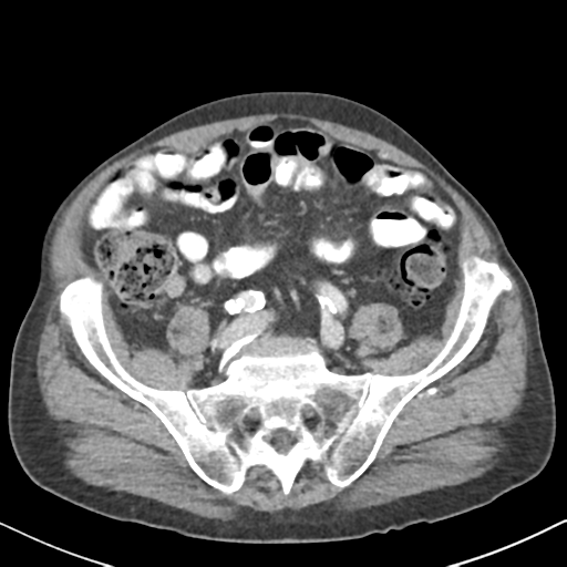 File:Amyand hernia (Radiopaedia 39300-41547 A 51).png