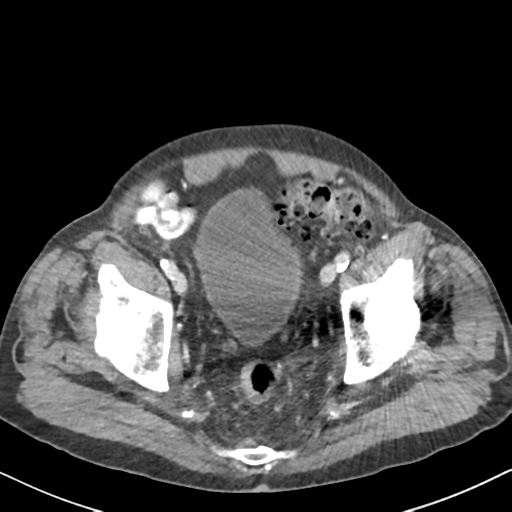 File:Amyand hernia (Radiopaedia 39300-41547 A 63).png