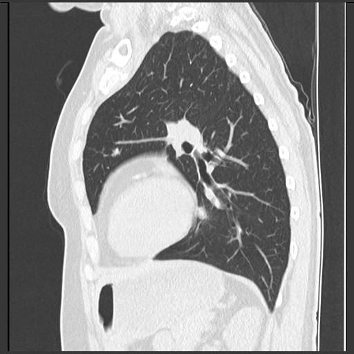 Amyloidosis - bronchial and diffuse nodular pulmonary involvement (Radiopaedia 60156-67744 F 37).jpg