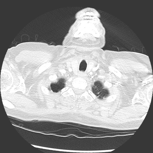 Amyloidosis - bronchial and diffuse nodular pulmonary involvement (Radiopaedia 60156-67745 Axial lung window 2).jpg