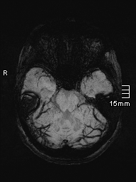 File:Amyotrophic lateral sclerosis (Radiopaedia 70821-81017 Axial SWI minIP 10).jpg