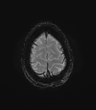 File:Anaplastic astrocytoma IDH mutant (Radiopaedia 50046-55341 Axial SWI 79).png