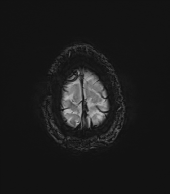 File:Anaplastic astrocytoma IDH mutant (Radiopaedia 50046-55341 Axial SWI 82).png