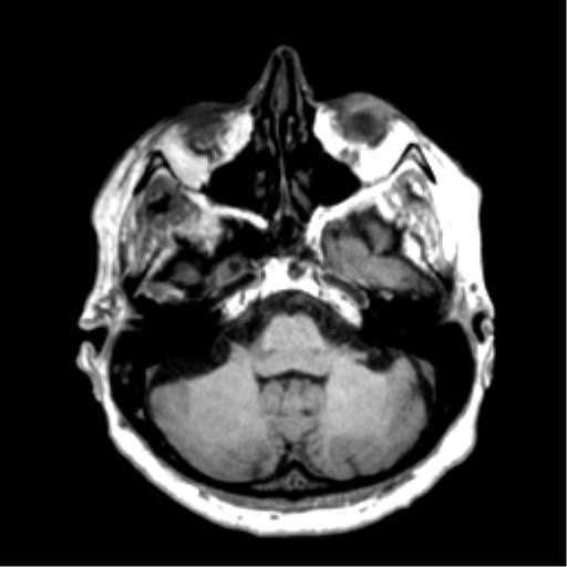 Anaplastic astrocytoma IDH wild-type (pseudoprogression) (Radiopaedia 42209-45277 Axial T1 29).png