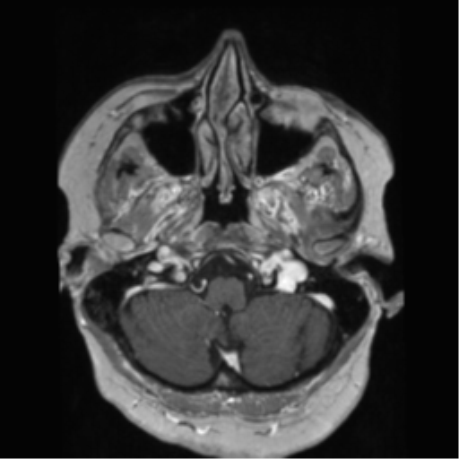 File:Anaplastic astrocytoma IDH wild-type (pseudoprogression) (Radiopaedia 42209-45278 Axial T1 C+ 35).png
