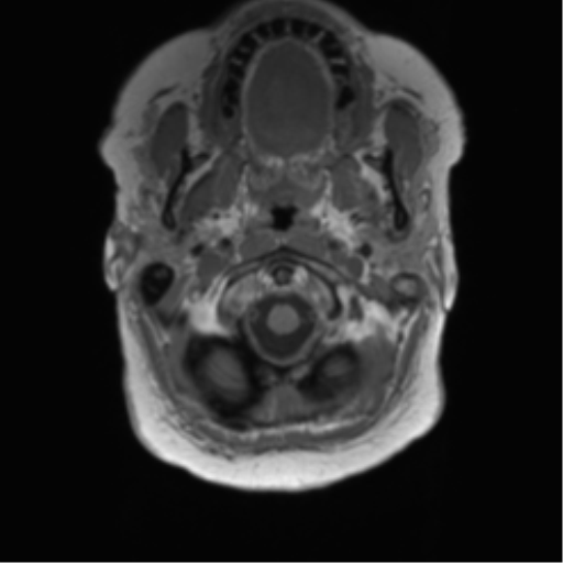 Anaplastic oligodendroglioma (Radiopaedia 83500-98599 Axial T1 6).png