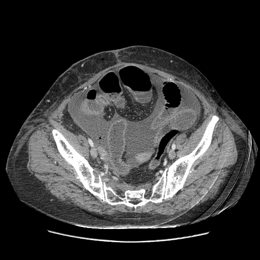 Anastomosis leak at ileostomy closure site (Radiopaedia 82138-96184 B 194).jpg