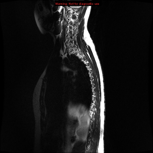 File:Aneurysmal bone cyst (Radiopaedia 9419-10103 G 12).jpg
