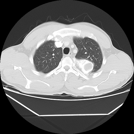 File:Aneurysmal bone cyst - rib (Radiopaedia 82167-96220 Axial lung window 21).jpg