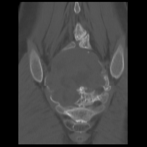 File:Aneurysmal bone cyst - sacrum (Radiopaedia 65190-74195 Coronal bone window 11).jpg