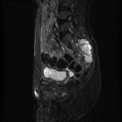 File:Aneurysmal bone cyst - sacrum (Radiopaedia 65190-74196 Sagittal STIR 20).jpg