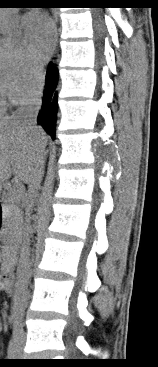 Aneurysmal bone cyst T11 (Radiopaedia 29294-29721 E 46).jpg