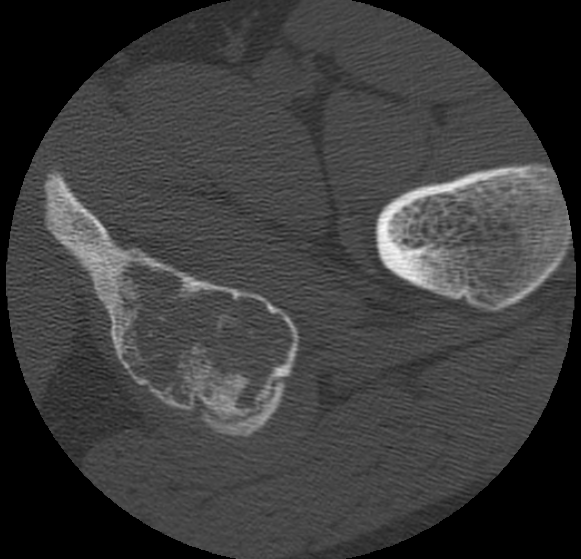 Aneurysmal bone cyst of ischium (Radiopaedia 25957-26094 B 41).png