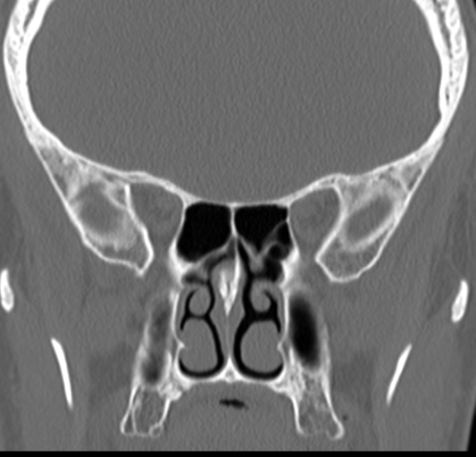 Angular epidermoid cyst (Radiopaedia 46908-51439 Coronal bone window 38).png