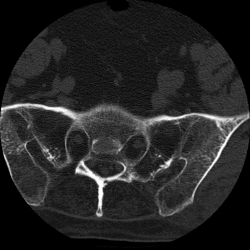 Ankylosing spondylitis complicated by fracture-dislocation (Radiopaedia 33583-34674 Axial non-contrast 163).jpg