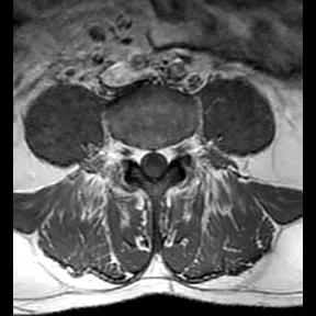 File:Ankylosing spondylitis with zygapophyseal arthritis (Radiopaedia 38433-40516 Axial T1 8).jpg