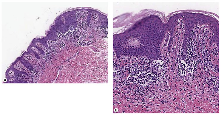 File:Annular lichenoid dermatitis histopathogy (DermNet NZ Annular-Lichenoid-Dermatitis-Fig-2-Histopathogical-features).jpg