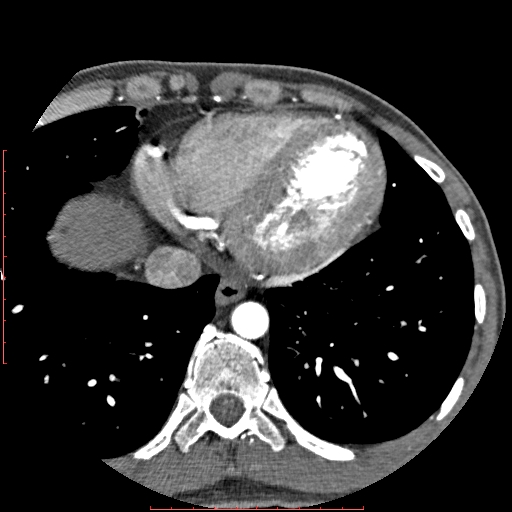 File:Anomalous left coronary artery from the pulmonary artery (ALCAPA) (Radiopaedia 70148-80181 A 305).jpg