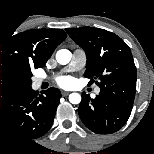 File:Anomalous left coronary artery from the pulmonary artery (ALCAPA) (Radiopaedia 70148-80181 A 37).jpg